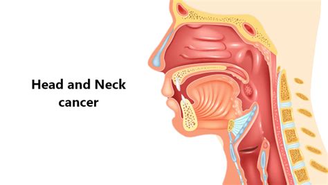 Or, the cause of a symptom may be a different medical. Head and neck cancer: Causes, Symptoms, Risk Factors ...