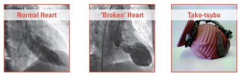 expert   broken heart syndrome university  iowa