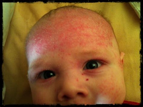 The Reality Of A Perfect Life Infantile Eczema And Baby Lactose Intolerance