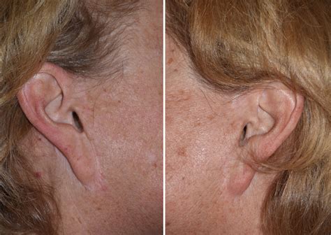 Plastic Surgery Case Report Correction Of Pixie Ear Deformity By