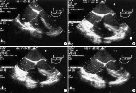 Venous Air Embolism Detected By Transesophageal Echocardiography