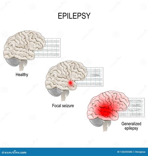 Eeg Normal Vs Epilepsy Imagingjes