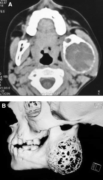 Intraosseous Cystic Lesions Of The Jaws In Children A Retrospective