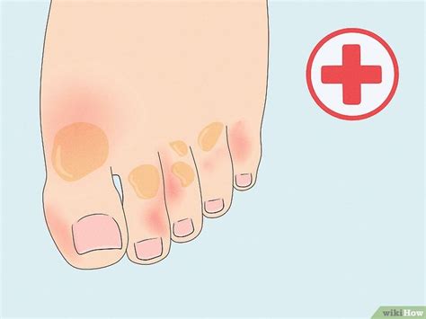 How To Treat Trench Foot Symptoms And Causes With Pictures