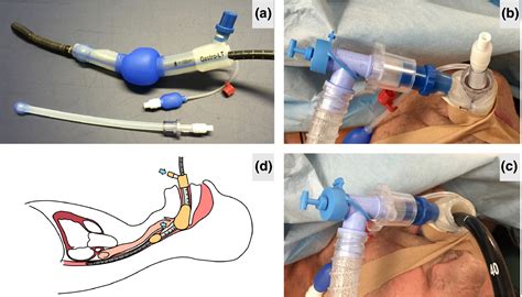 Supraglottic Airway Device Use For Transoesophageal Echocardiography