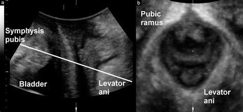 Ultrasound In The Investigation Of Posterior Compartment Vaginal