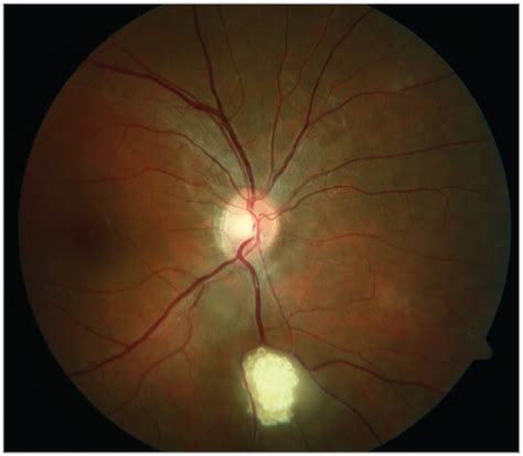 A White Lesion In The Retina Neuro Ophthalmology Jama Ophthalmology