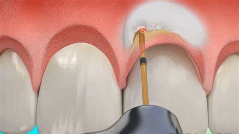 Waterlase Dental Laser Iowa Dentistry
