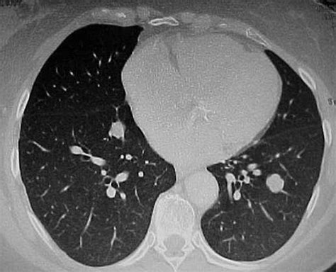 A 69 Year Old Female With Multiple Bilateral Pulmonary Nodules