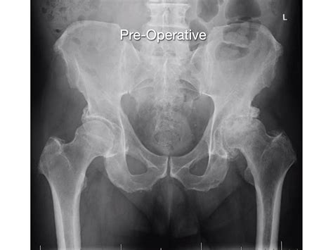 Direct Anterior Hip Arthroplasty Rodriguez Hip And Knee