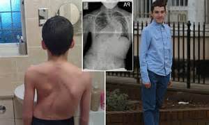 Teenager With Scoliosis Grows Five Inches Overnight After Operation To Straighten His Spine