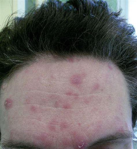 Pleva Like Syphilis Papules And Plaques On The Forehead Download