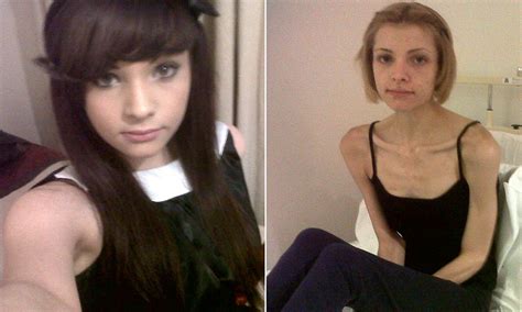 Anorexic Sian Clarke 19 Is Passed Between Five Hospitals After Her