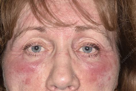 Eczema On The Face Stock Image C0472820 Science Photo Library