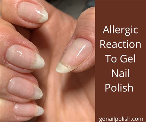 How To Treat An Allergic Reaction To Gel Nail Polish