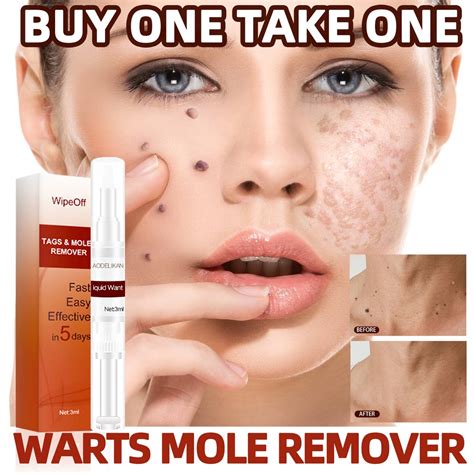 warts mole remover cream original skin tag wart remover original genital warts remover effective