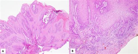 Histologic Presentation Of Proliferative Verrucous Leukoplakia A