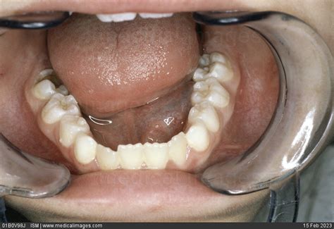 Stock Image Close Up Of A Ranula A Cyst On The Floor Of The Mouth