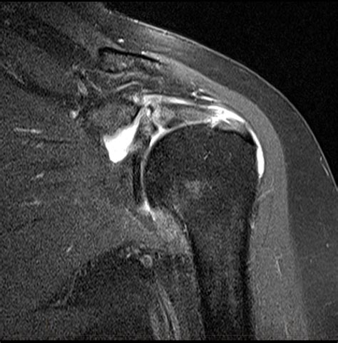 Anterior Supraspinatus Tendon Tear With Associated Medial Subluxation