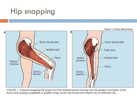 Snapping Hip Mississauga Chiropractor And Physiotherapy Clinic Free Consult