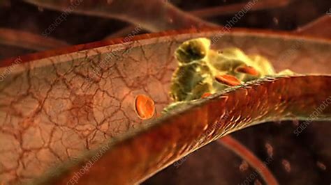 Blocked Blood Vessel Stock Video Clip K0015149 Science Photo Library