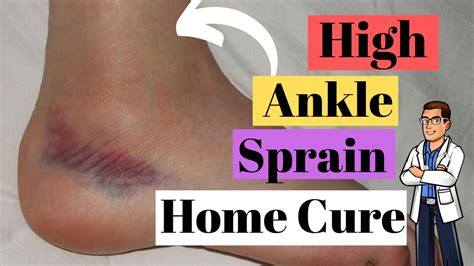 High Ankle Sprain Treatment Causes And Best Recovery Time 2022 Youtube