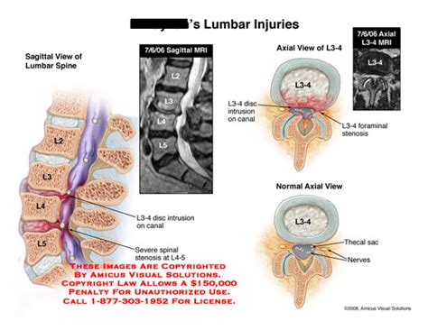 Amicus Illustration Of Amicusinjurylumbardiscintrusionstenosisl3