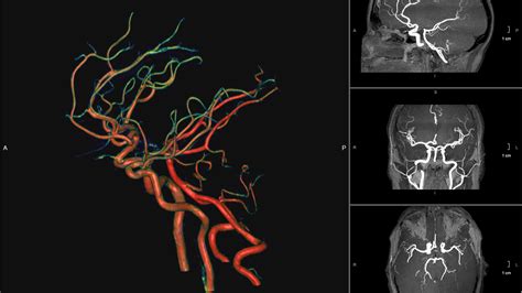 Division Of Neuroradiology Columbia Radiology