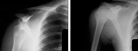 The Painful Shoulder Part Ii Acute And Chronic Disorders Aafp