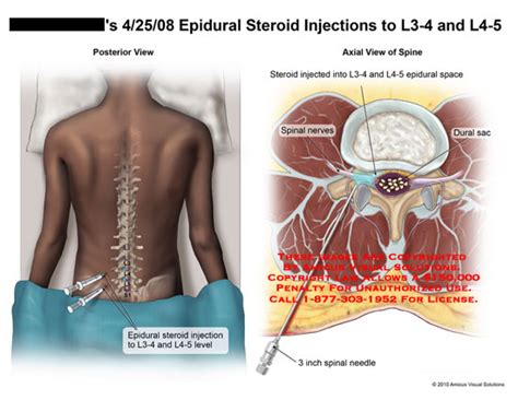 Amicus Illustration Of Amicus Surgery Injection Epidural Steroid L L