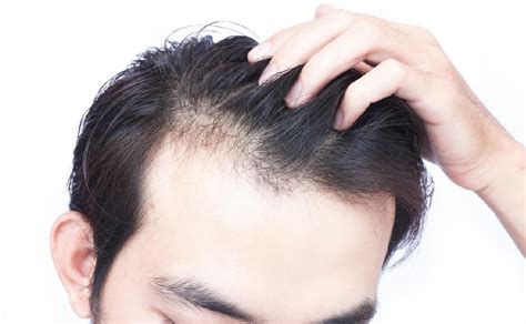 male or female pattern baldness symptoms and treatment