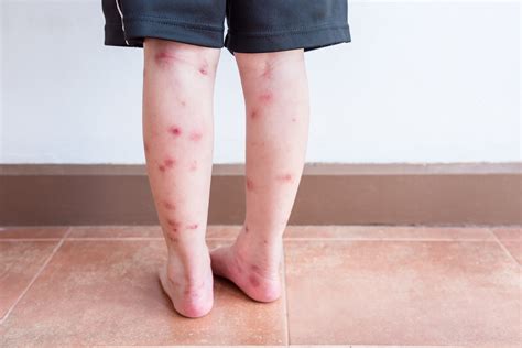Bed Bug Bites Symptoms Treatment And Prevention Terminix