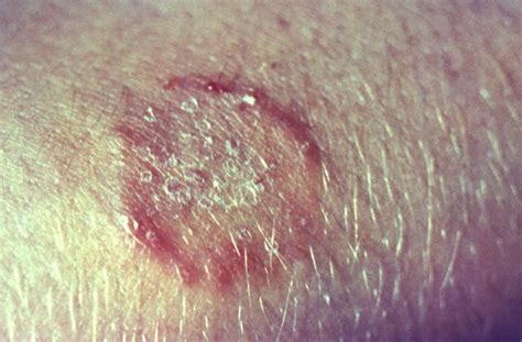 Information For Healthcare Professionals Ringworm Types Of Diseases