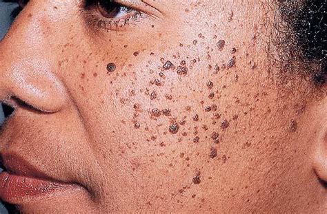 Dermatosis Papulosa Nigra الجلاد الحطاطي الأسود