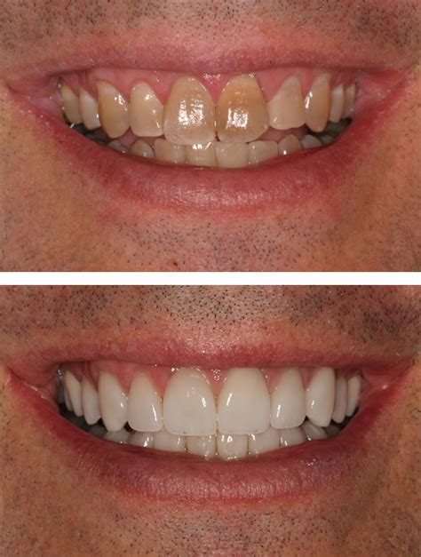 If your teeth are yellow, you may need a soft white porcelain. Porcelain Veneers Minneapolis | Gorman Center for Fine ...