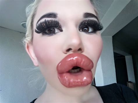 Bulgarian Woman Aspiring To Have Biggest Lips In The World Undergoes 20th Injection The