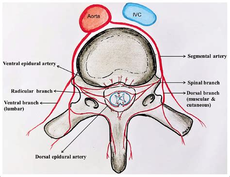 Dorsal Epidural Artery Pseudoaneurysm An Unusual Complication After