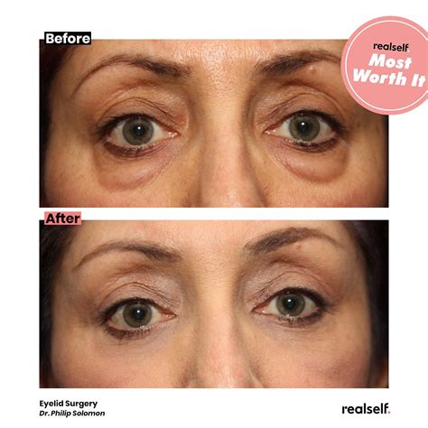 How Long Eyelid Surgery Results Last And More Answers Realself
