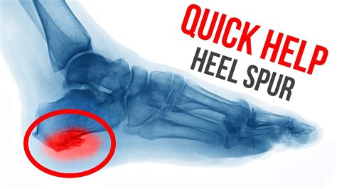 What Is A Heel Spur Ph