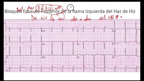 Diagnostico Electrocardiografico De Bloqueo Fasciculo Posterior De La