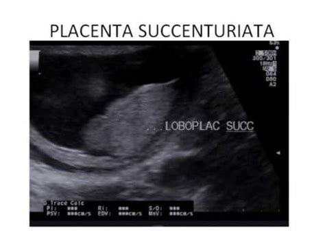The risk of placenta accreta spectrum in women with in vitro whole blood transfusion reduces overall component transfusion in cases of placenta accreta. Placenta succenturiata - YouTube