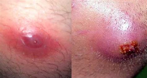 An ingrown hair that appear in your armpit can be painful with a lot of problems. Home - Lightskincure