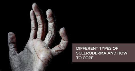 Different Types Of Scleroderma Causes Symptoms And Treatment