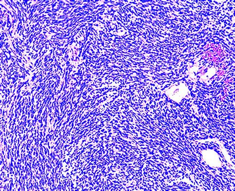 Pathology Outlines Schwannoma Cellular