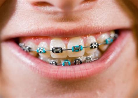 Choosing Colours For Your Braces Greater Vancouver Orthodontics