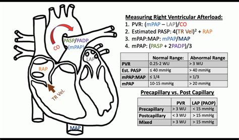 Right Heart Failure Understanding The Hemodynamics Part 4 Treating