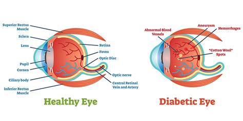 What Is Diabetic Retinopathy The Eye Center Of North Florida