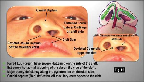 The Surgical Technique For Unilateral Cleft Lip Nasal Deformity