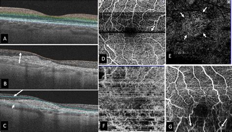 Image Artefacts In Swept Source Optical Coherence Tomography