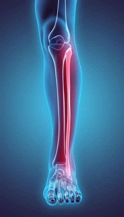 Fibular Fracture